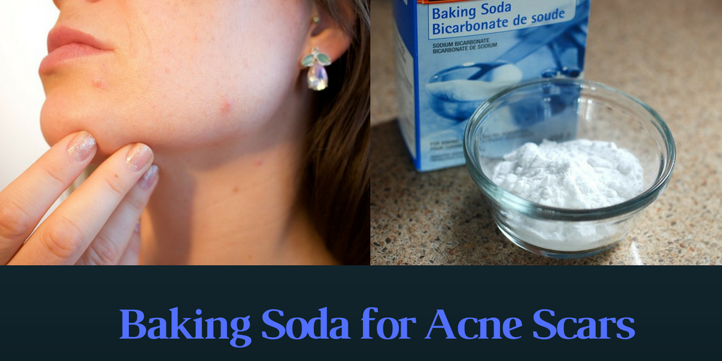 Baking Soda for Acne Scars: Magical Cure for Skin